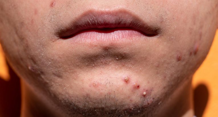 acne na pele: como tirar as manchas que permanecem no rosto?