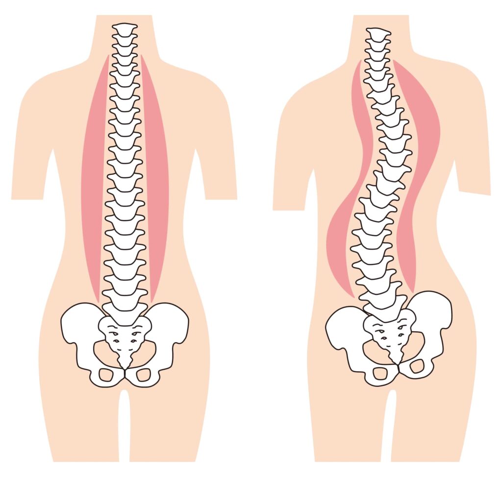 o que é escoliose
